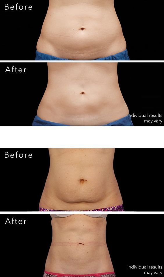 Sculpting the Midsection: Can Liposuction Replace a Tummy Tuck?